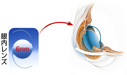 乱視用・単焦点・多焦点眼内レンズ